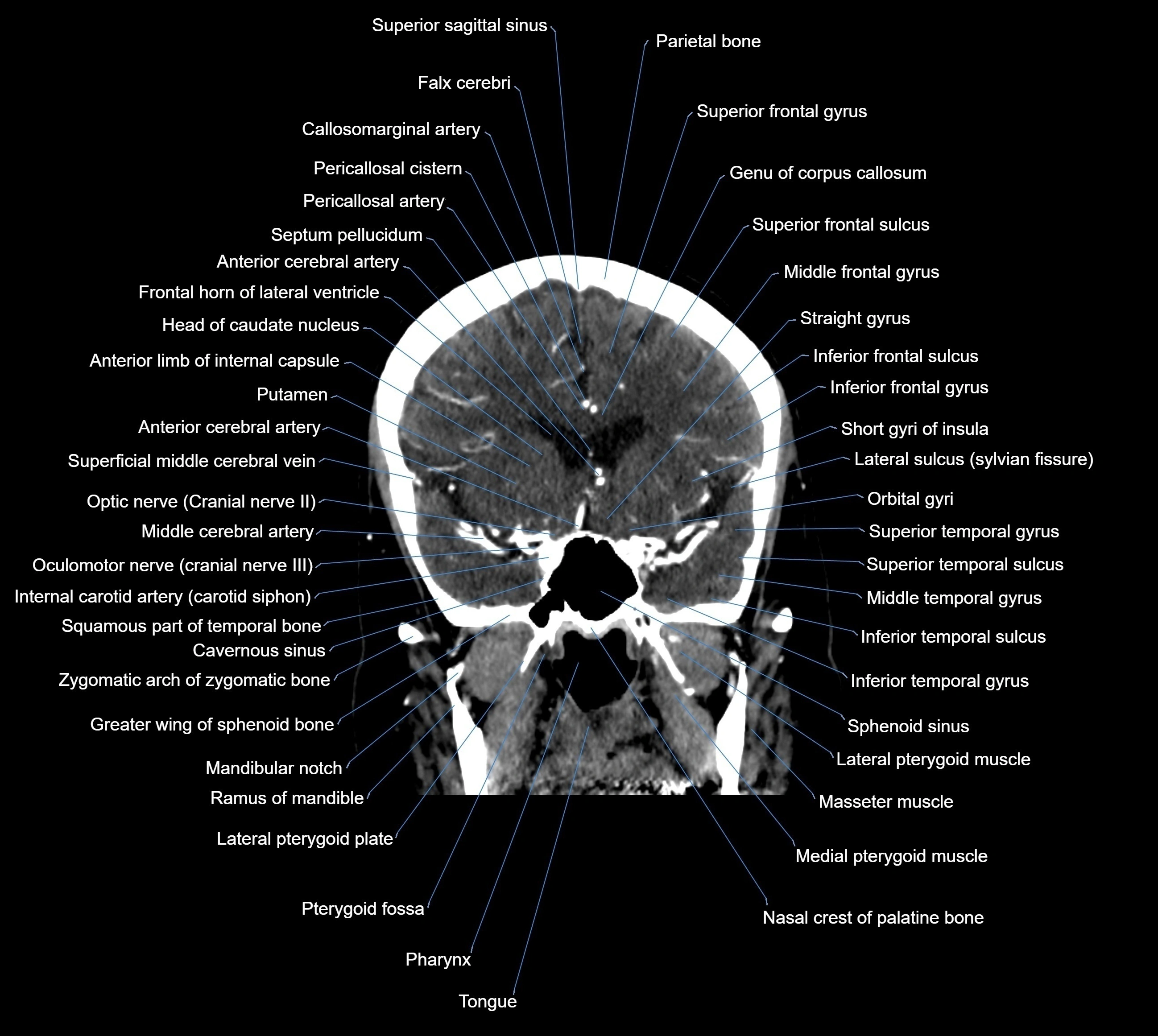CT Brain coronal cross sectional radiology anatomy image  -img-00001-018.webp